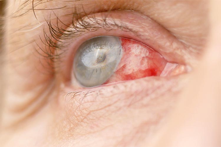 白内障イメージ写真