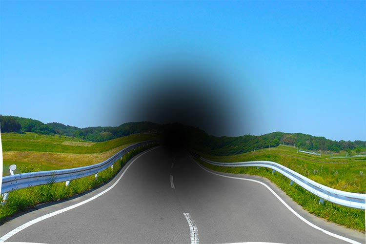 加齢黄斑変性のイメージ写真