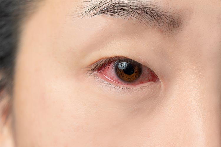 目が赤いイメージ写真